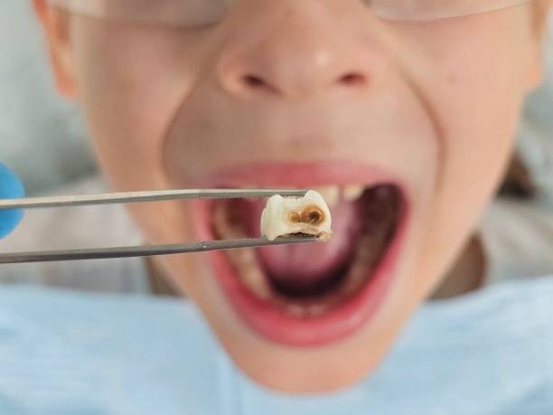 Best Emergency Tooth Extraction in Cle Elum, WA